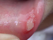 Lip ulcer