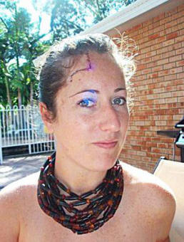 Bree Wailes after the skin cancer was cut out of her forehead.