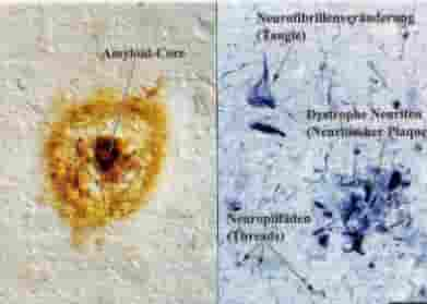 brain amyloid