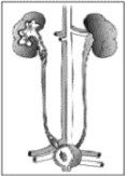 Illustration of kidney stones in kidney, ureter, and bladder