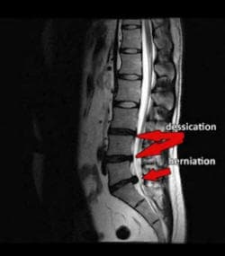 MRI L5-SI DISC