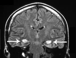 Limbic Encephalitis