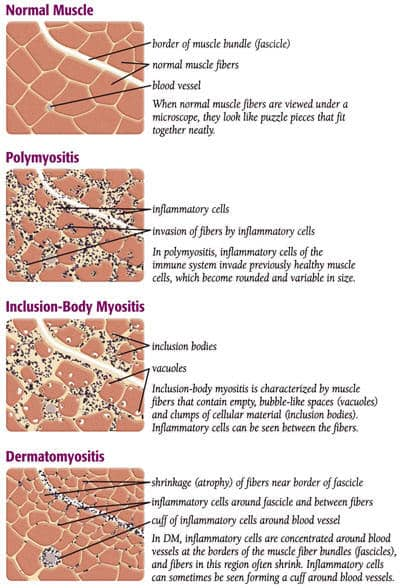 Myositis